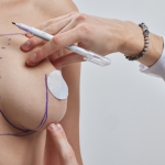 Brasil é modelo na especialização de cirurgiões de mama em técnicas oncoplásticas